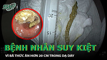 Bã Thức Ăn Hơn 20 Cm Trong Dạ Dày Khiến Bệnh Nhân Suy Kiệt |SKĐS