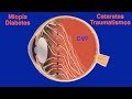 Desprendimiento de Vítreo: Cuerpos flotantes, moscas y luces - Centro de Oftalmología Bonafonte