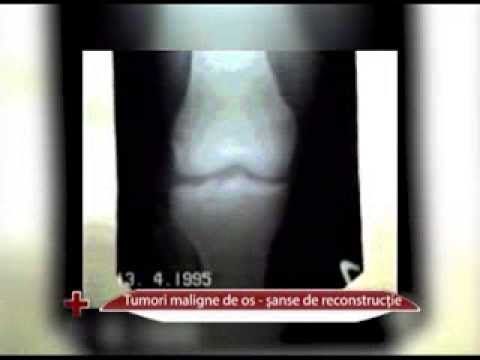 Video: Durerea De Osteosarcom