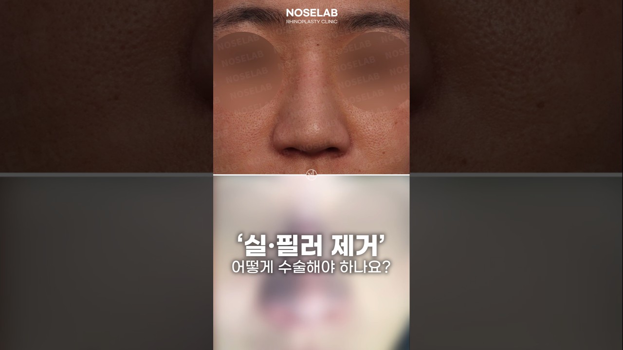 코필러&middot;미스코실 후 코라인이 뭉툭해졌다면? 제거 후 자연스러운 코재수술 포인트 총정리