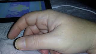 Involuntary Thumb/finger movement any ideas?It does this intermittently and not continuously Thumb Jerking