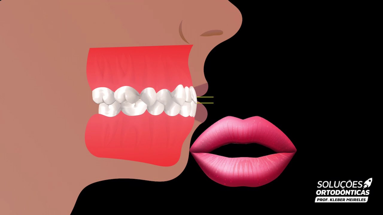 Elásticos para fechamento de mordida aberta anterior