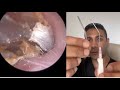 1510  extremely itchy dead skin accumulation removed from ear  learn about zoellner suction probe