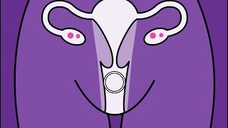 Brook Contraception - Vaginal Ring Animation screenshot 4