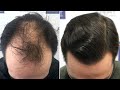 FUE Hair Transplant (3225 Grafts NW IV - NOT MEDICATED) By Dr Juan Couto - FUEXPERT CLINIC, Spain