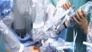 Robotics and Gyn Cancer