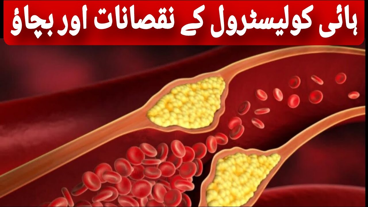 High Cholesterol ke nuqsanat or bachay | Risks of High Cholesterol | Prevention |