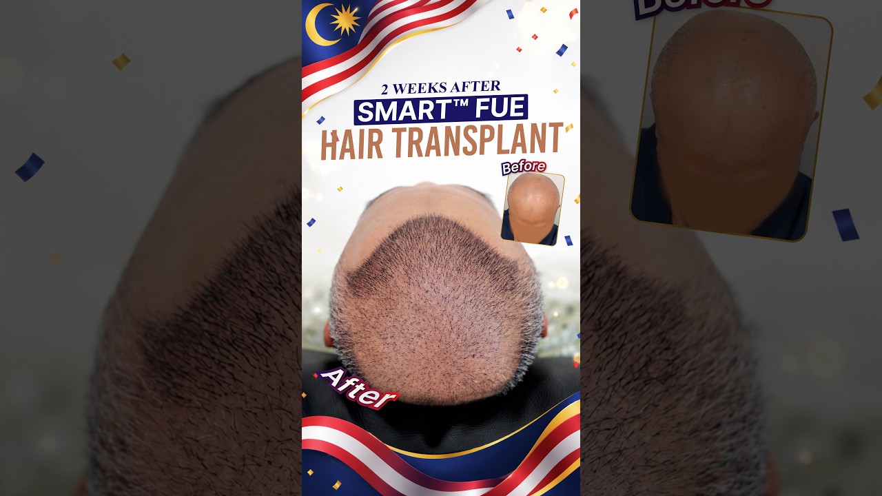 Hair Transplant Malaysia l 2 Weeks In: SMART™ FUE Progress! 🤩 #hairtransplantmalaysia