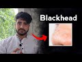 Blackheads    how to remove blackheads at home  nepali yogi