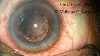 Phaco , Direct Chop , Triphobic HD IOL , 25/05/26