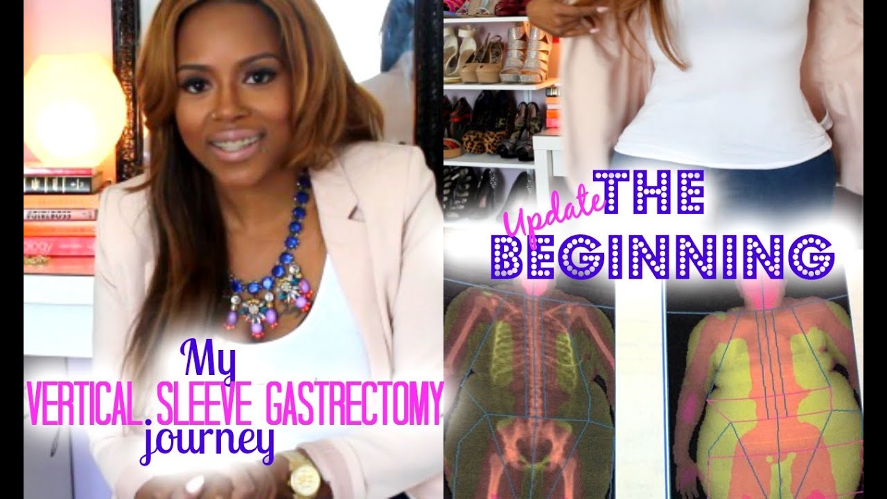 Gastric Sleeve Post Op 1 Year Update And How To Get Started YouTube