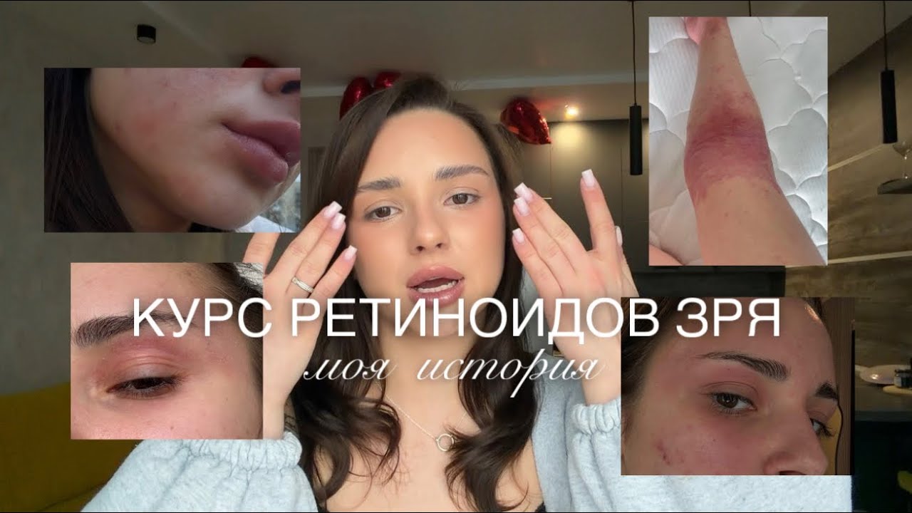 ПОБОЧКА ИЛИ ОШИБКА ВРАЧА? / Ретиноиды / Моя история  