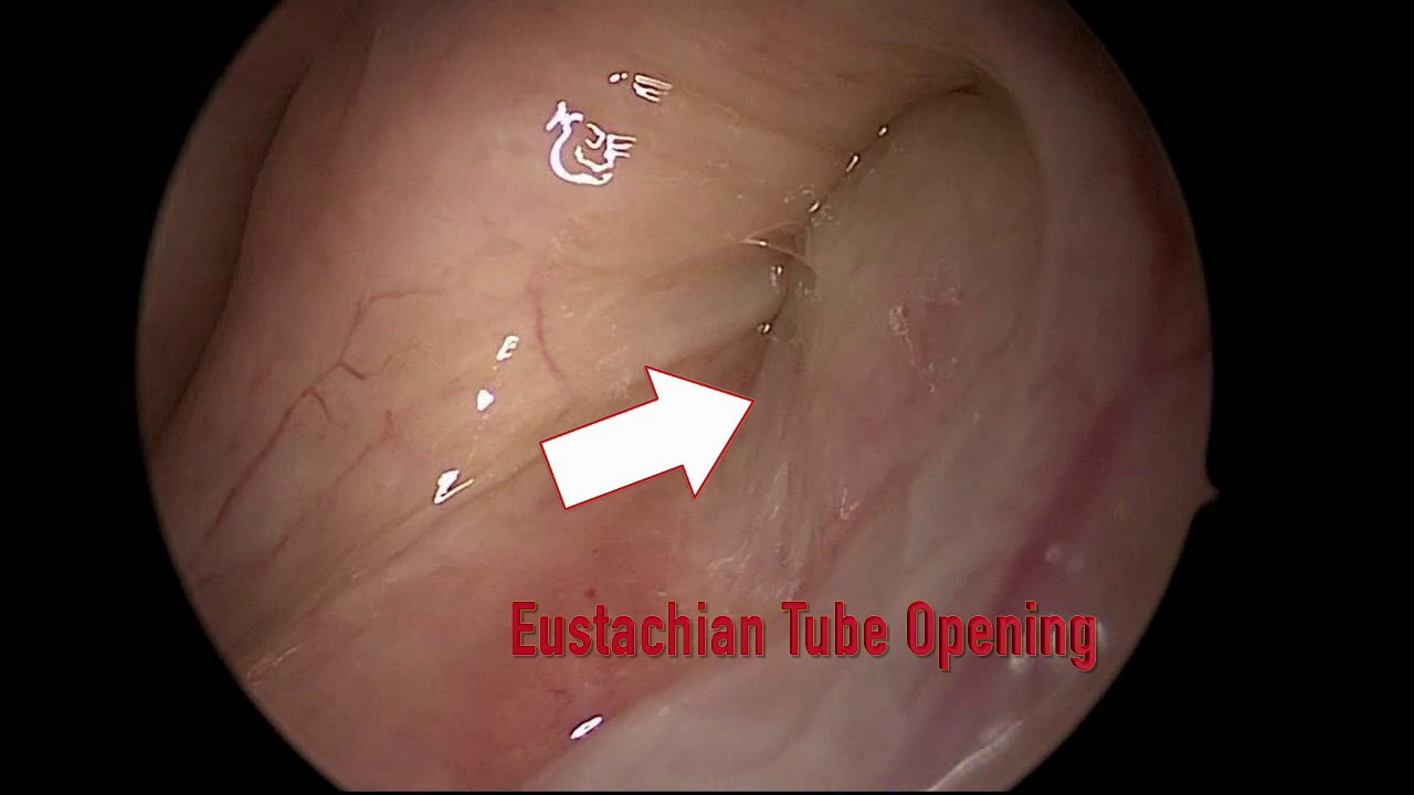 komme til syne maling balkon Eustachian Tube Dysfunction – Ear, Balance and Eustachian Tube