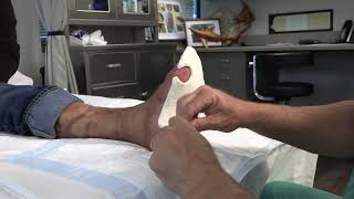 How to Use Adhesive Felt to Relieve Plantar Pressure