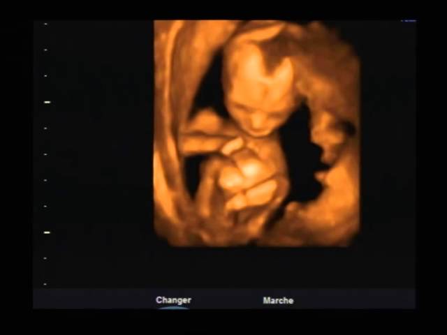 Bebe Art Echo Echographie 3d Valenciennes Youtube
