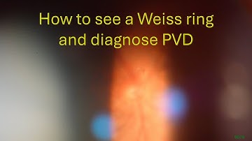 0077: How to see a Weiss ring and diagnose a PVD