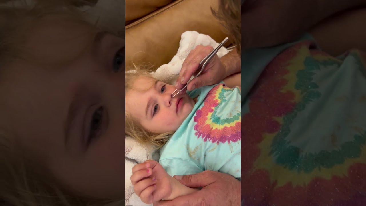Dad Has To Use Tweezers Remove A Pony Bead From His Daughter S Nose 