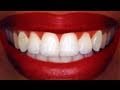 "Homemade" Teeth Whitening