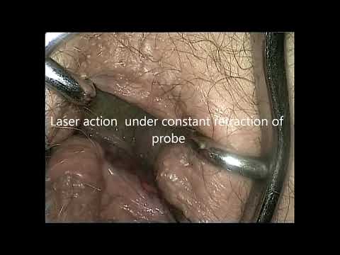 Biolitec laser operacija fistula