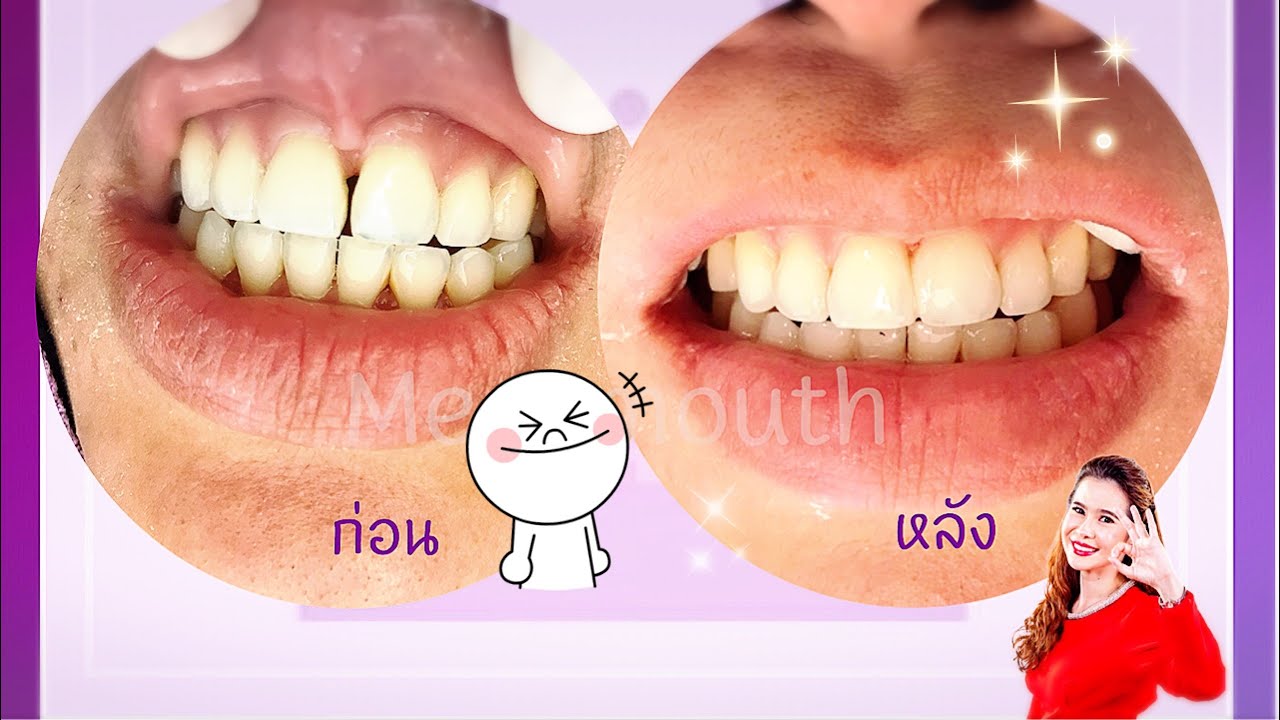 ฟันห่าง