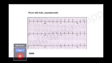 ECG (Part 3)- Trainee Tutorial | Dr. Pradeep Rangappa
