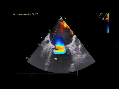 Treatment of Severe Functional Mitral Regurgitation using three Mitraclips