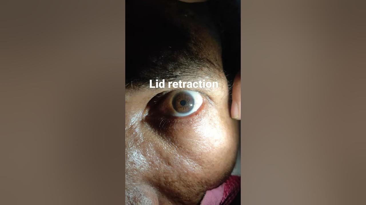 lid retraction and pupillary hippus - YouTube