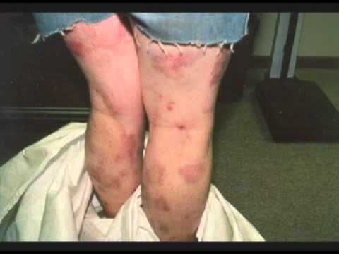 management of shock Meth or Death meth.wmv