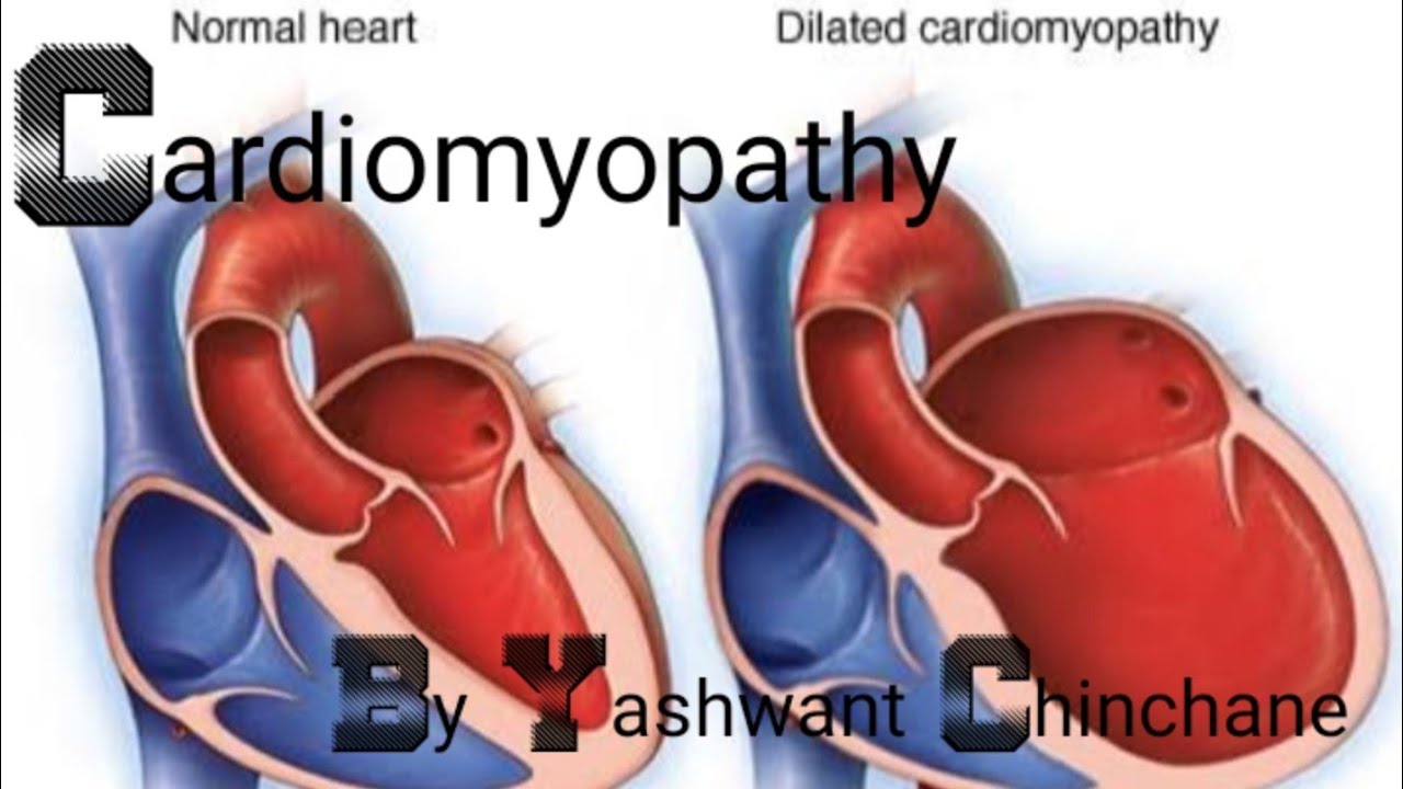 Cardiomyopathy | Types of Cardiomyopathy - YouTube