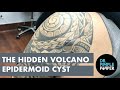 The Hidden Volcano Cyst