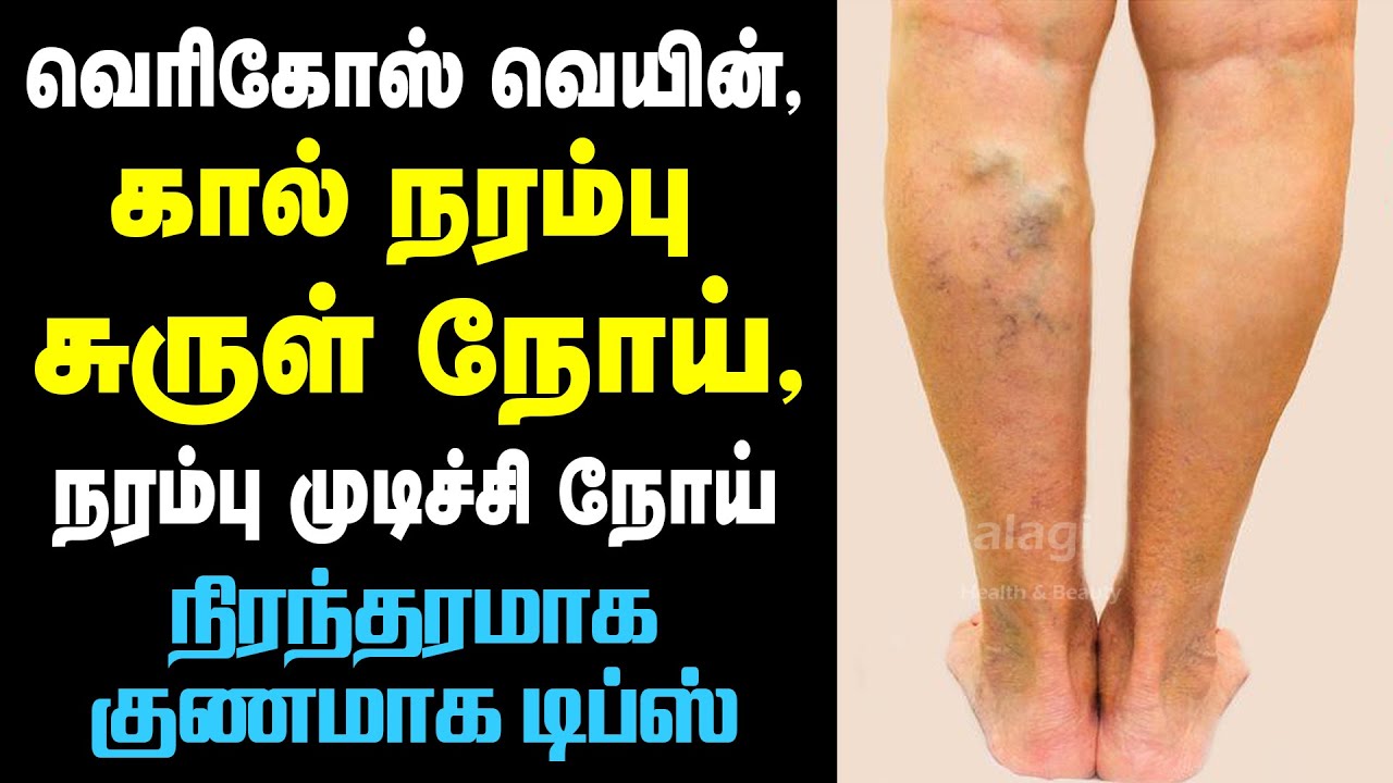mode dupa funcionare varicose tratamentul medicamentelor populare varicoza picior