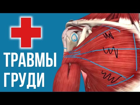 ТРАВМЫ ГРУДНЫХ МЫШЦ - разрыв, отрыв, растяжение, операции, лечение | Жим Лежа