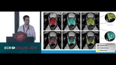 Automatic prostate and prostate zones segmentation of MR images using DenseNet-like U-net