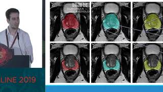 Famous Automatic prostate and prostate zones segmentation of MR images using DenseNet-like U-net Wealth