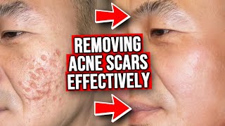 ELIMINATE YOUR ACNE SCARS (FROM EXPERIENCE)