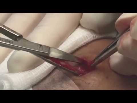 Lipoma Removal On A Young Woman's Forehead. For Medical Education- NSFE.