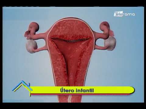 Video: ¿Cuál es el significado de útero hipoplásico?