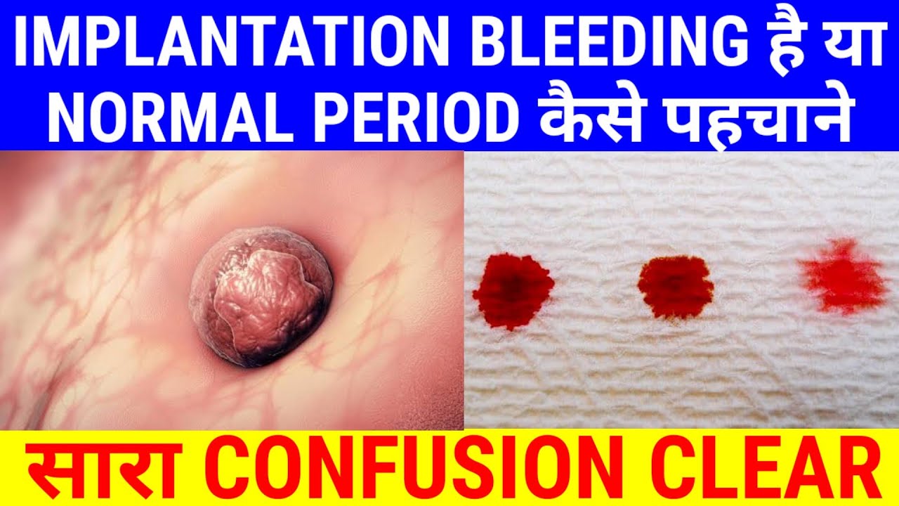 Implantation Bleeding Vs Period – difference between implantation ...