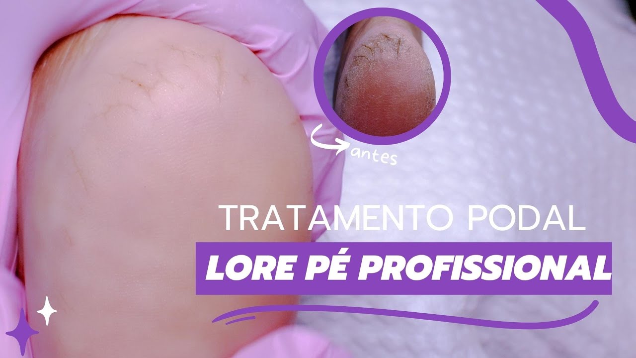 Tratamento Podal com a LorePé Profissional