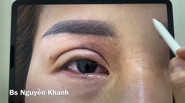 Tại sao mắt hốc không được cắt mí? Hậu quả nếu làm sai sẽ ra sao?