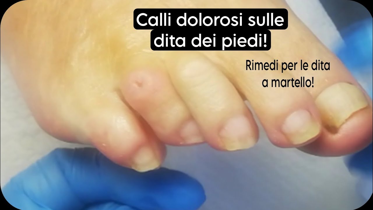 calli-dolorosi-sulle-dita-dei-piedi-rimedi-naturali-youtube