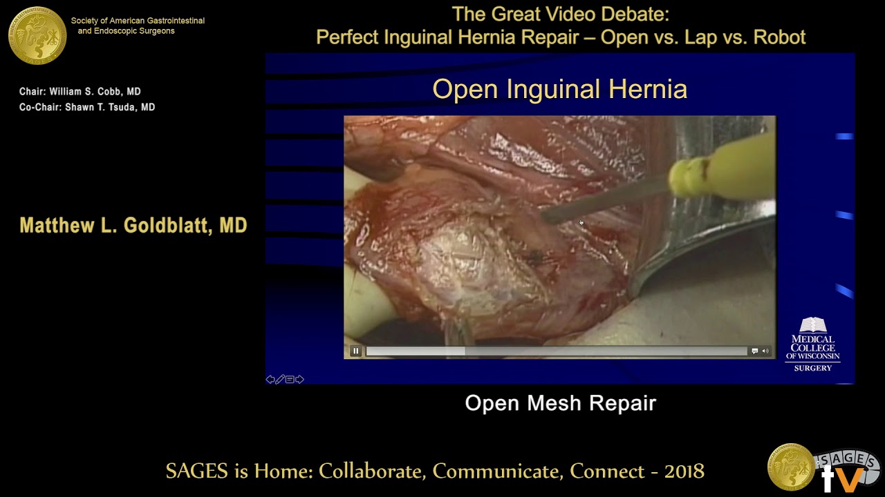 Pdf Tension Free By Mesh Plug Technique For Inguinal Hernia