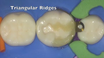 Complex Composite Restoration