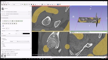 Region Growing Segmentation with 3DSlicer