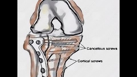 Anterolateral Approach to the Lateral Tibial Plateau.