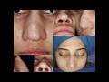 Revision Rhinoplasty by Dr Saadat Ullah | Pakistan