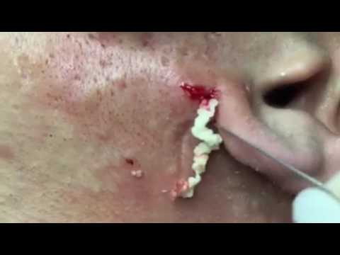 Wow Amazing!!! huge cyst removal on man&#;s jawline - Acne Removal Video #