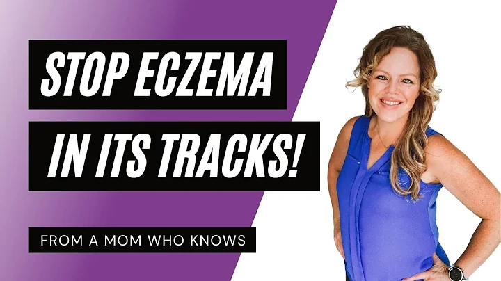 How to Get Rid of Eczema Naturally