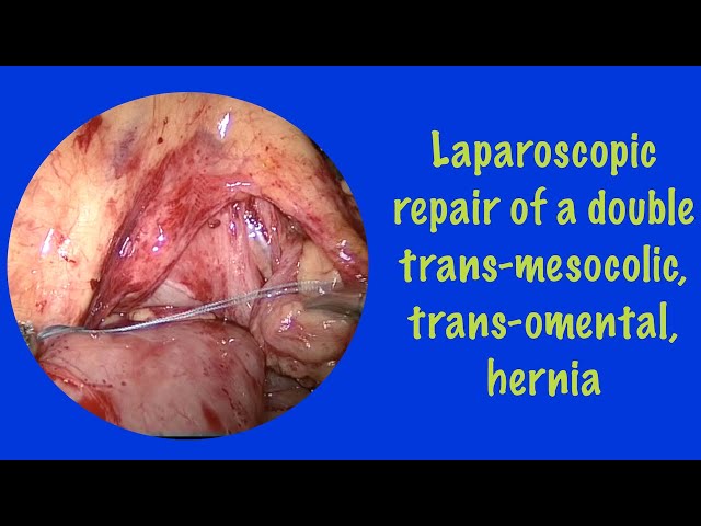 Laparoscopic repair of a double trans-mesocolic, trans-omental hernia