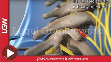 ESI Epidural Steroid Injection 3D animation